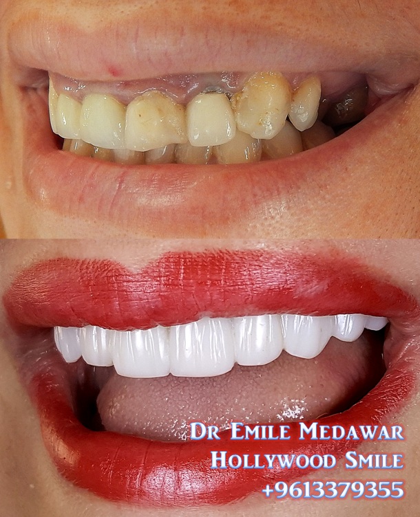 Composite Veneers 1 Composite Veneers Lebanon