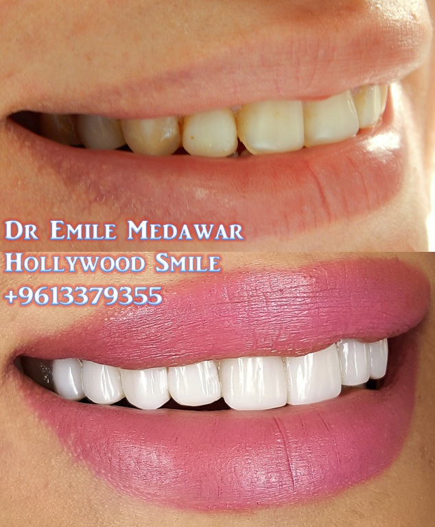Composite Veneers 1 Composite Veneers Lebanon