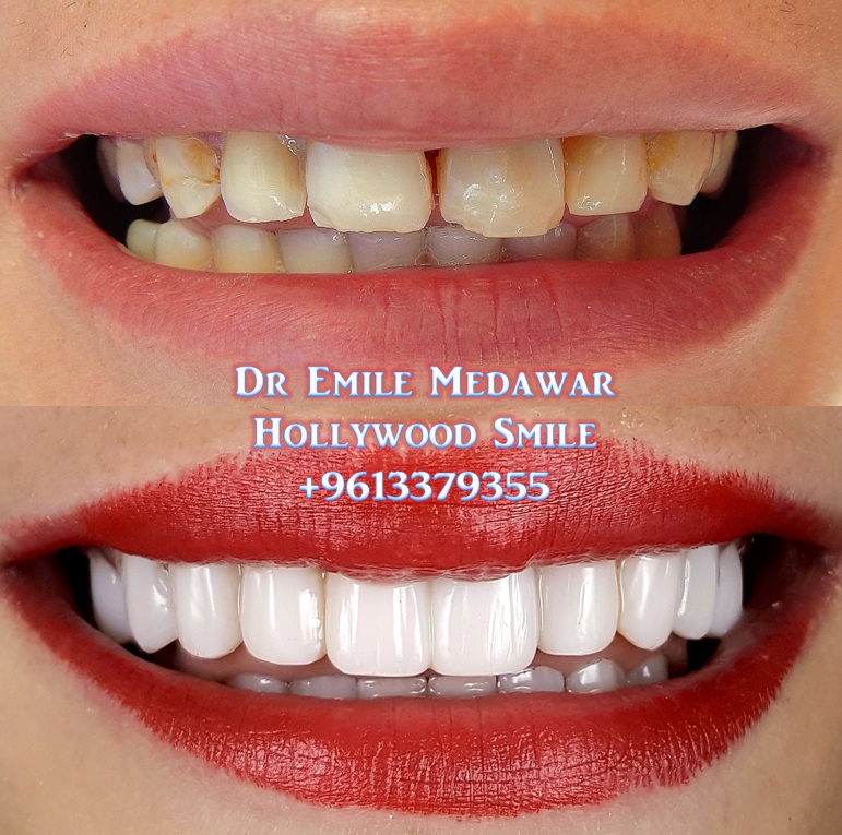 Composite Veneers 1 Composite Veneers Lebanon