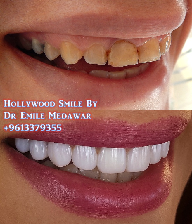 Composite Veneers 1 Composite Veneers Lebanon